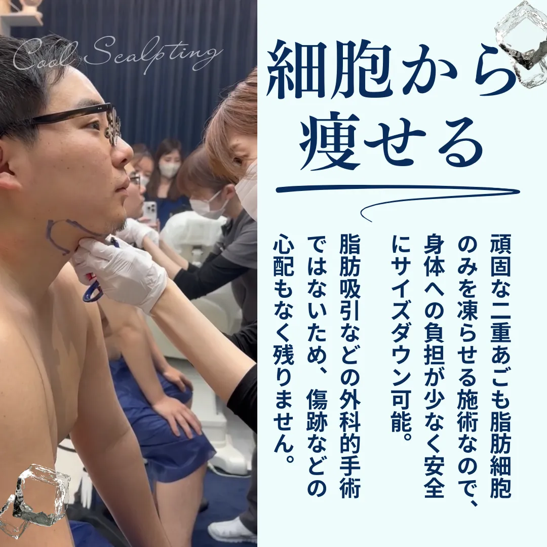 平日限定　あご肉は冷却破壊　最安値！今だけ29,700円！あご下施術START！　クールスカルプティング